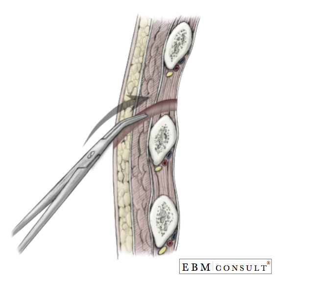 Chest Tube Placement Thoracostomy Procedure